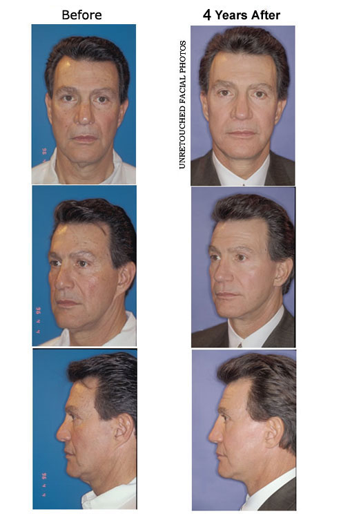 Don Ettore before and after
