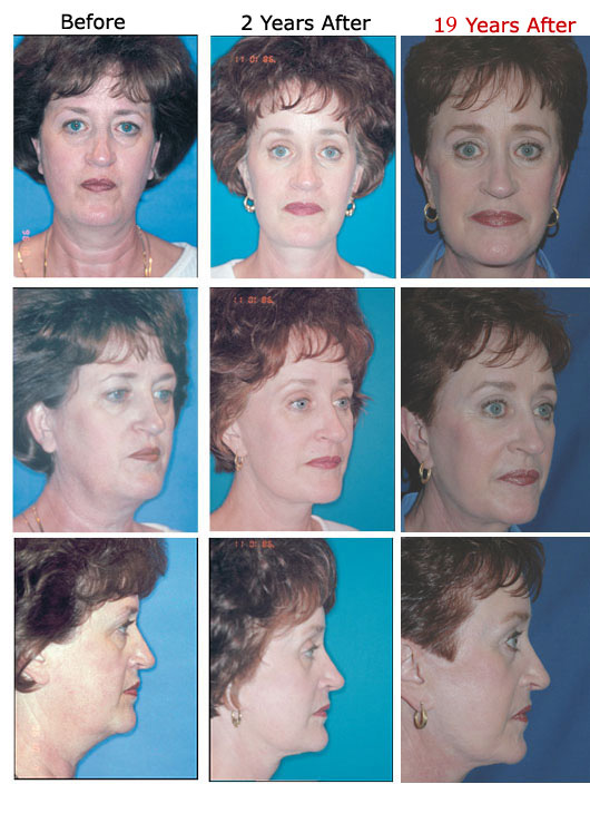 Linda Findling before and after