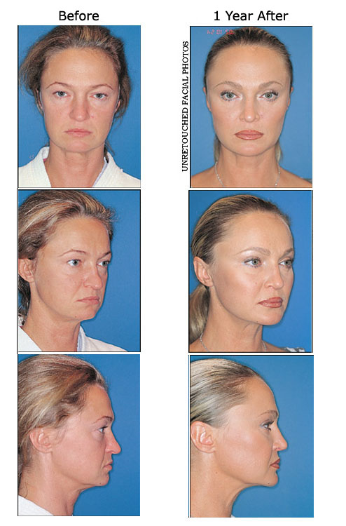 Olga Zeyer before and after