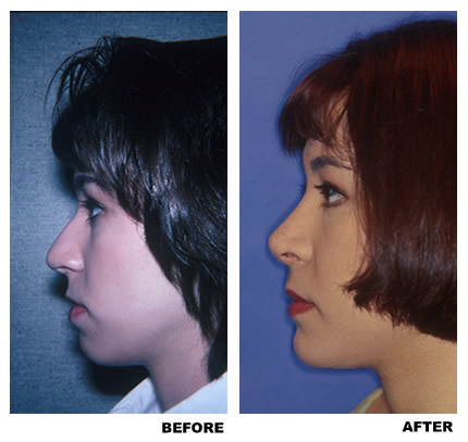 Rhinoplasty before and after photo, patient 1