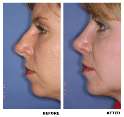 Rhinoplasty before and after photo, patient 5