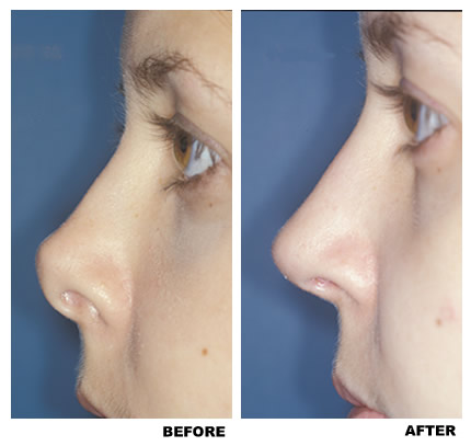 Rhinoplasty before and after photo, patient 6