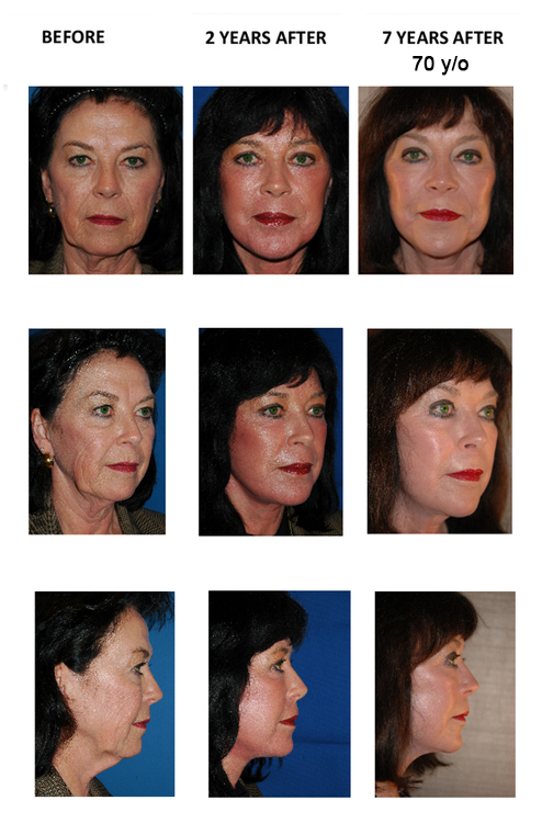 Virgie before and after