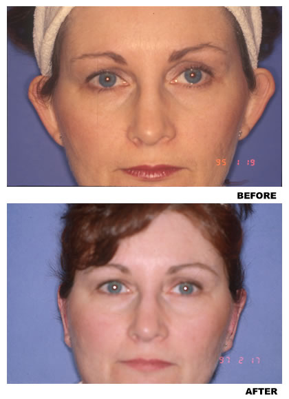 Otoplasty before and after photo 1