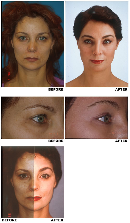 Browlift before and after photo 1