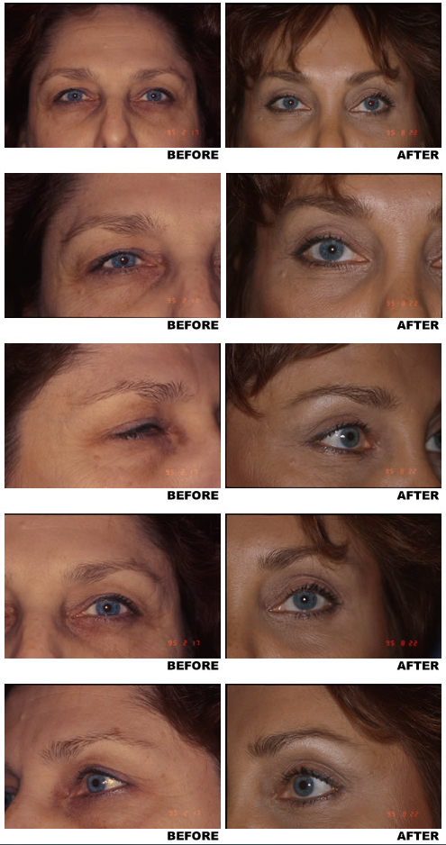 Browlift before and after photo 2