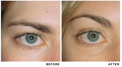 Browlift before and after photo 4