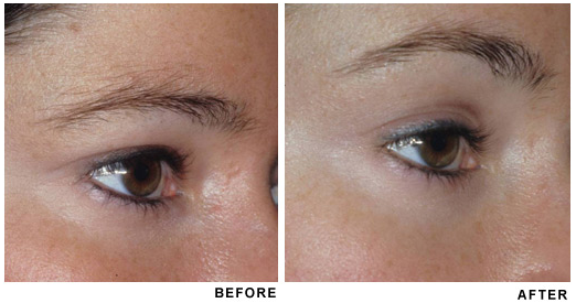 Browlift before and after photo 5