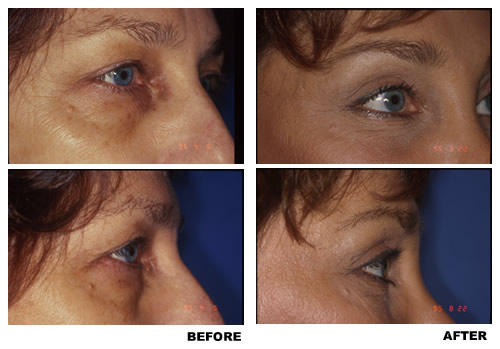 Blepharoplasty before and after photo 1