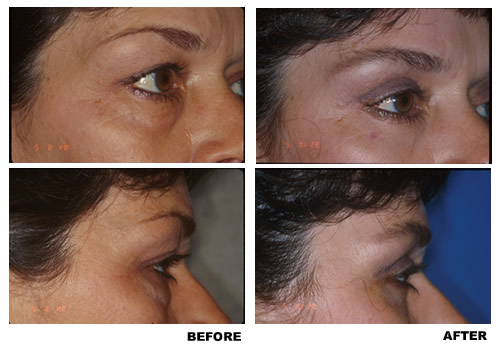 Blepharoplasty before and after photo 2