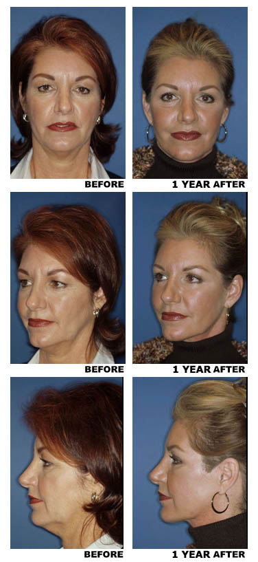 Facelift before and after photo 10