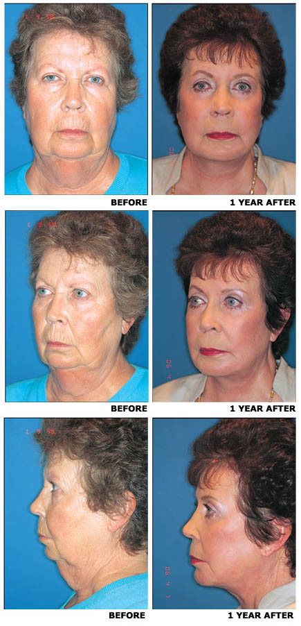 Facelift before and after photo 11