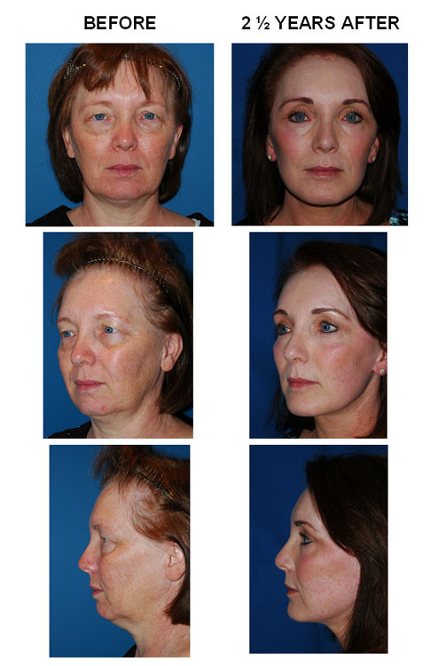 Facelift before and after photo 12