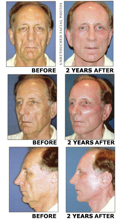 Facelift before and after photo 6