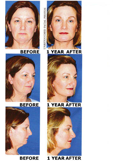 Facelift before and after photo 7