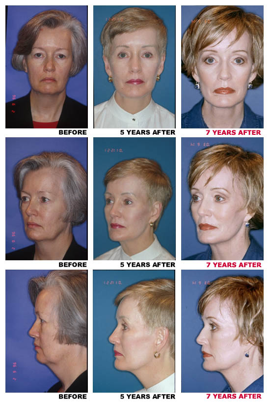 Facelift before and after photo 9