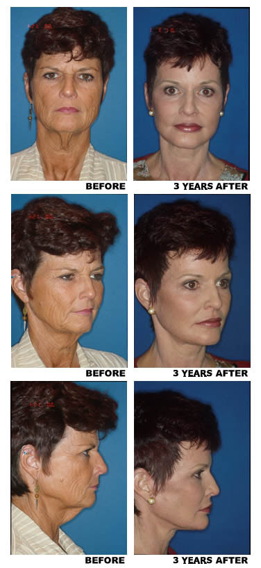Facelift before and after photo b