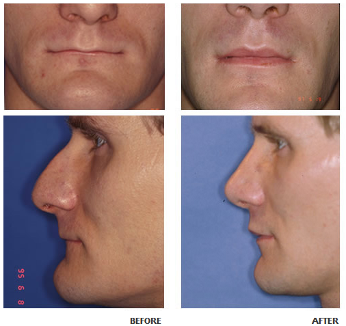 Lip augmentation before and after photo 1