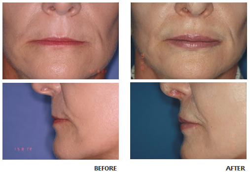 Lip augmentation before and after photo 2