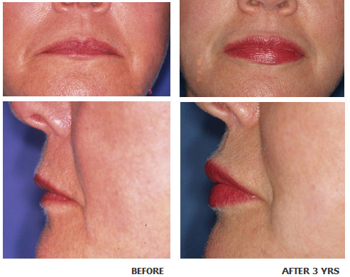 Lip augmentation before and after photo 3