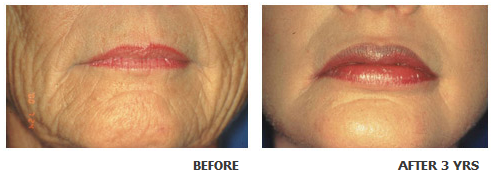 Lip augmentation before and after photo 4