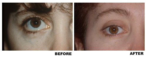 Lower eyelid canthoplasty before and after photo 2