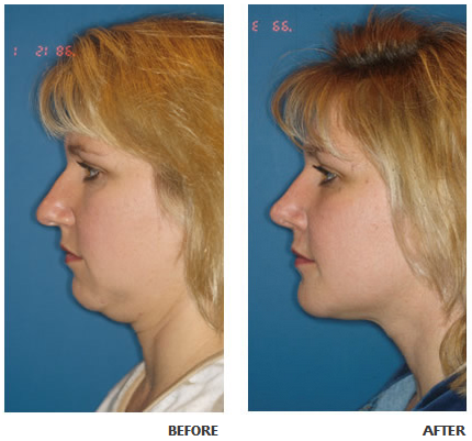 Necklift before and after photo 1