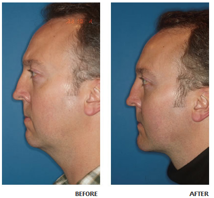 Necklift before and after photo 2