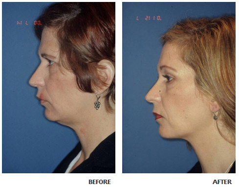Necklift before and after photo 3