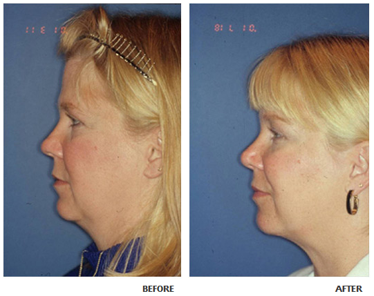 Necklift before and after photo 4