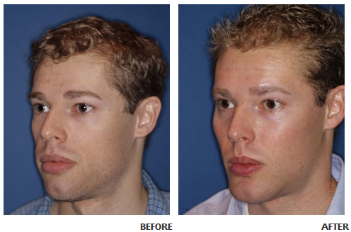 Cheek implant before and after photo 2