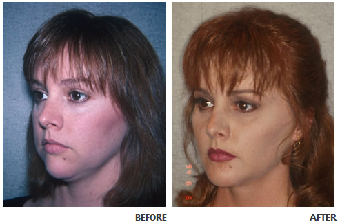 Cheek implant before and after photo 3
