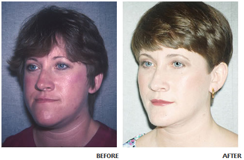 Cheek implant before and after photo 4