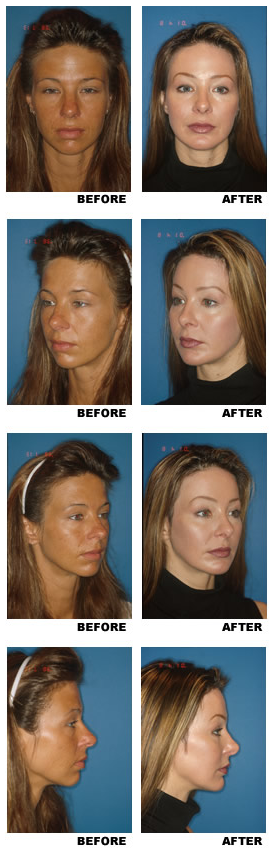 Midfacelift before and after photo, patient 2