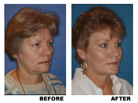 Midfacelift before and after photo, patient 3
