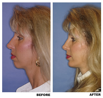 Chin implant before and after photo 3
