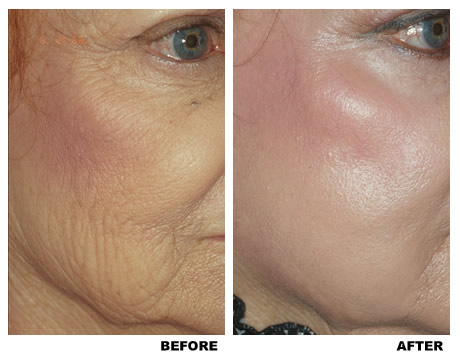 Laser skin resurfacing before and after photo 1