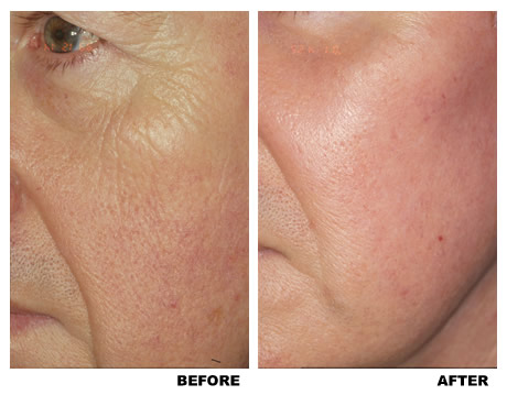Laser skin resurfacing before and after photo 2